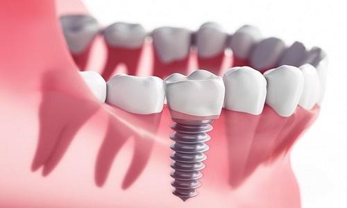 Dental Implant