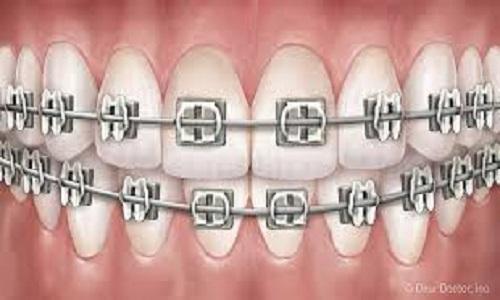 Orthodontics Treatment