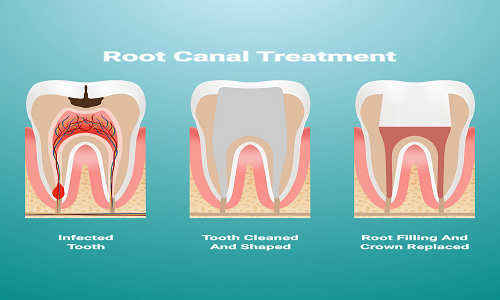 Root Canal