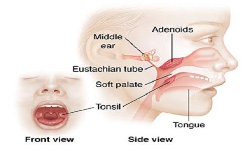 Tonsillectomy & Adenectomy With Coblation