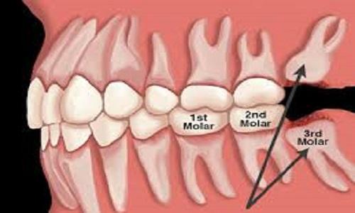 Wisdom Tooth Surgery